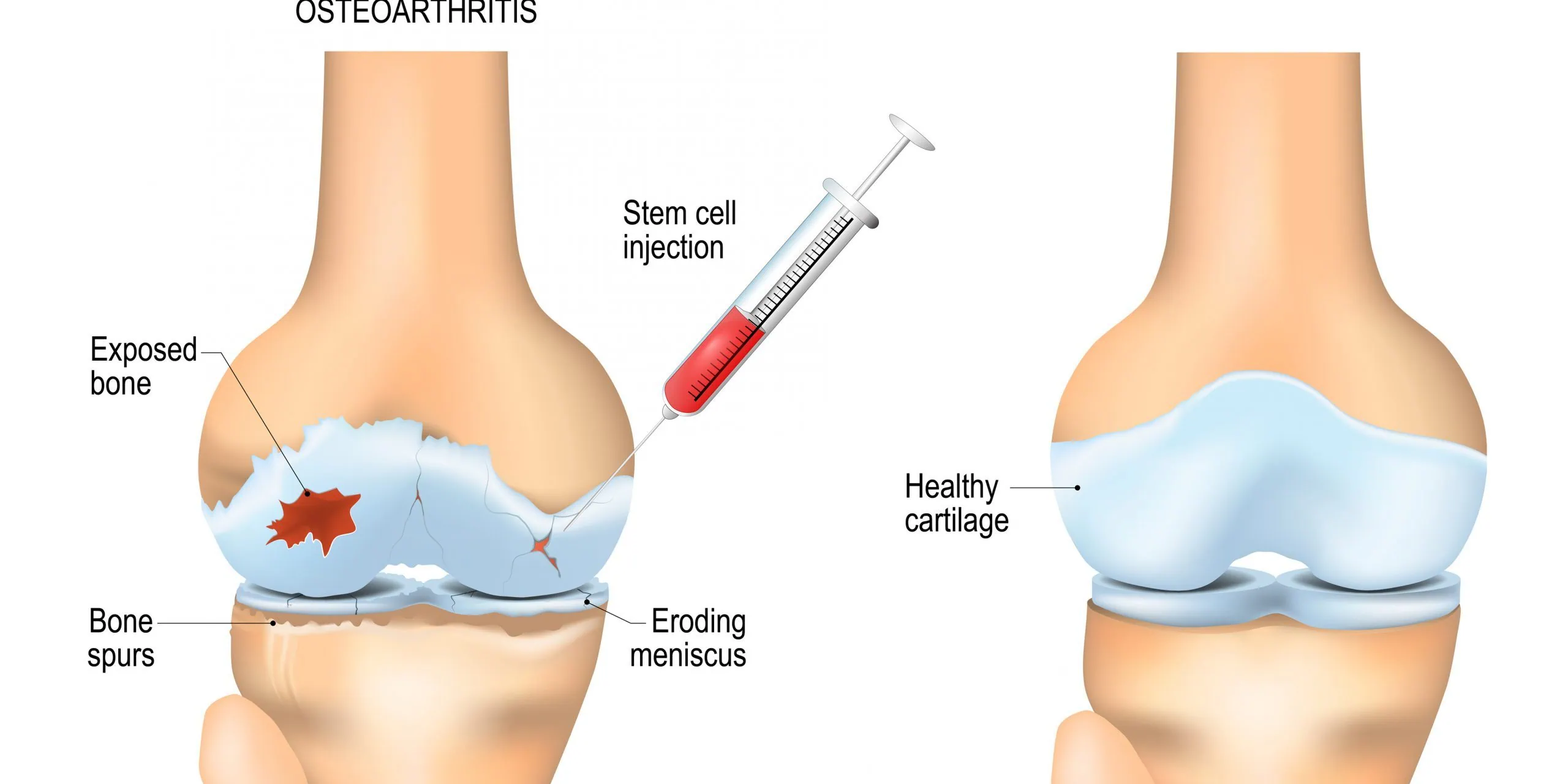 Stem Cell Therapy for Arthritis by Santee, CA by The Wellness Co.