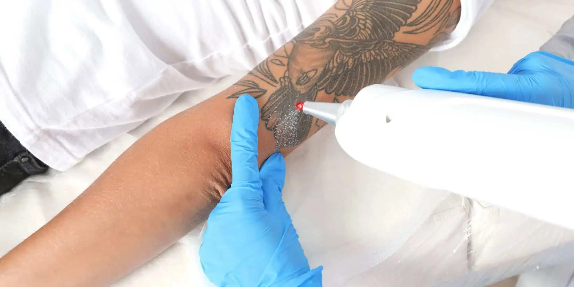 Does Laser Tattoo Removal Leave a Scar?