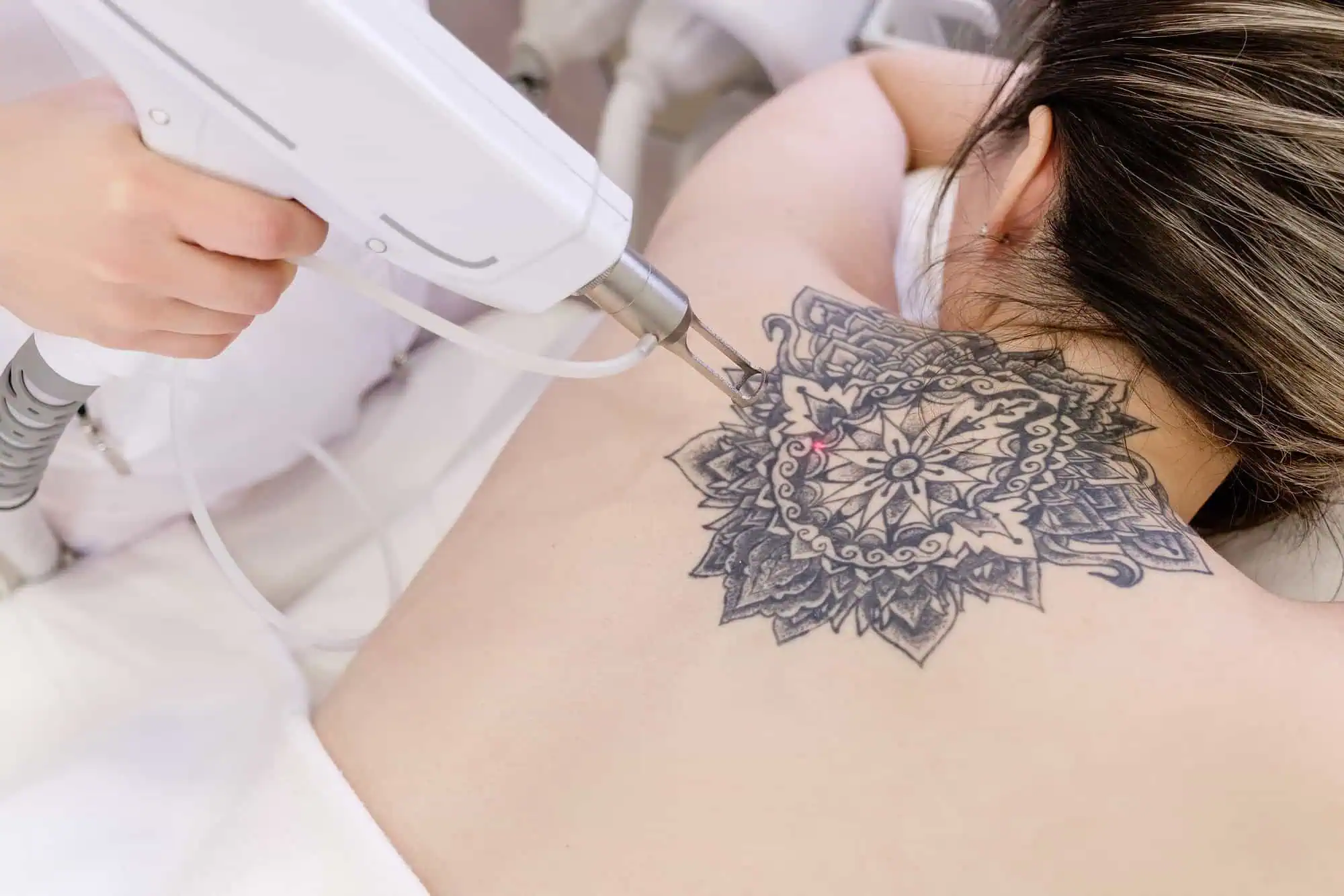 How Many Sessions Do You Need for Effective Laser Tattoo Removal?